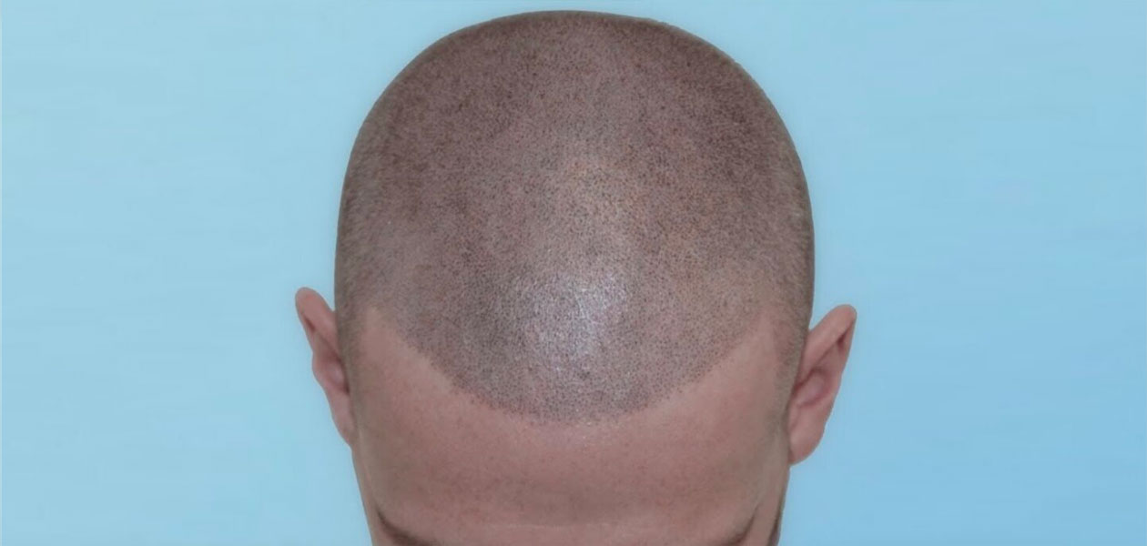 Post-Operative Hair Care - Hair Transplant From Turkey