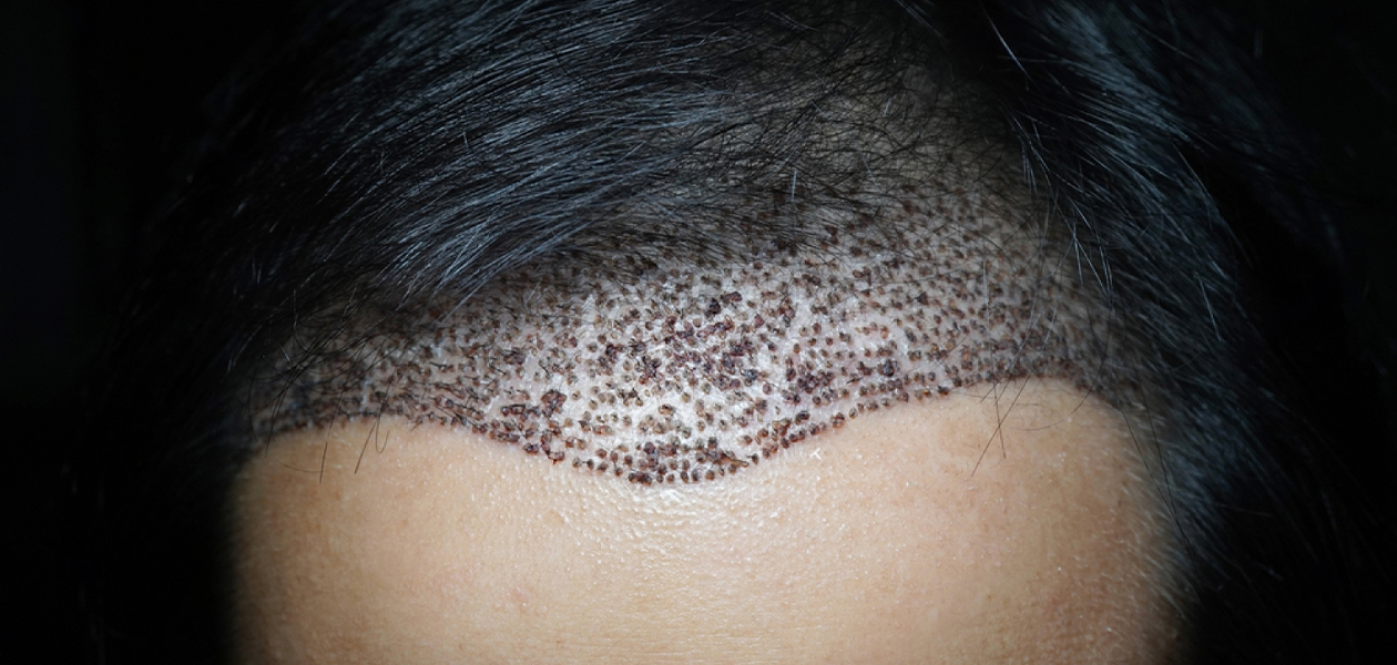how long does it take to recover after a hair transplant
